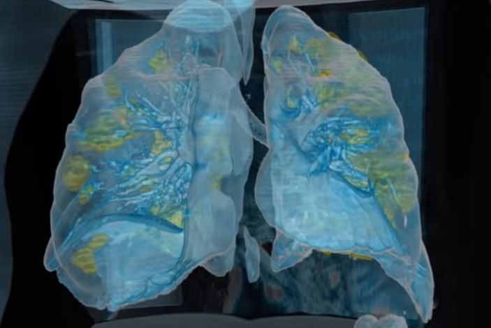 Modèle poumons 3D